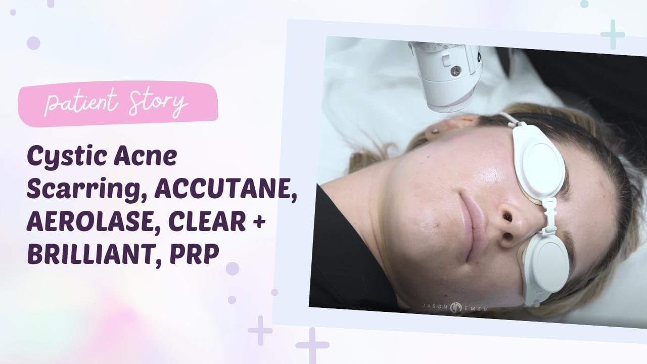 Watch a hyperpigmentation & melasma procedure video