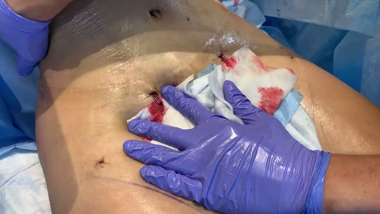 Watch a abdominal lipo for women procedure video