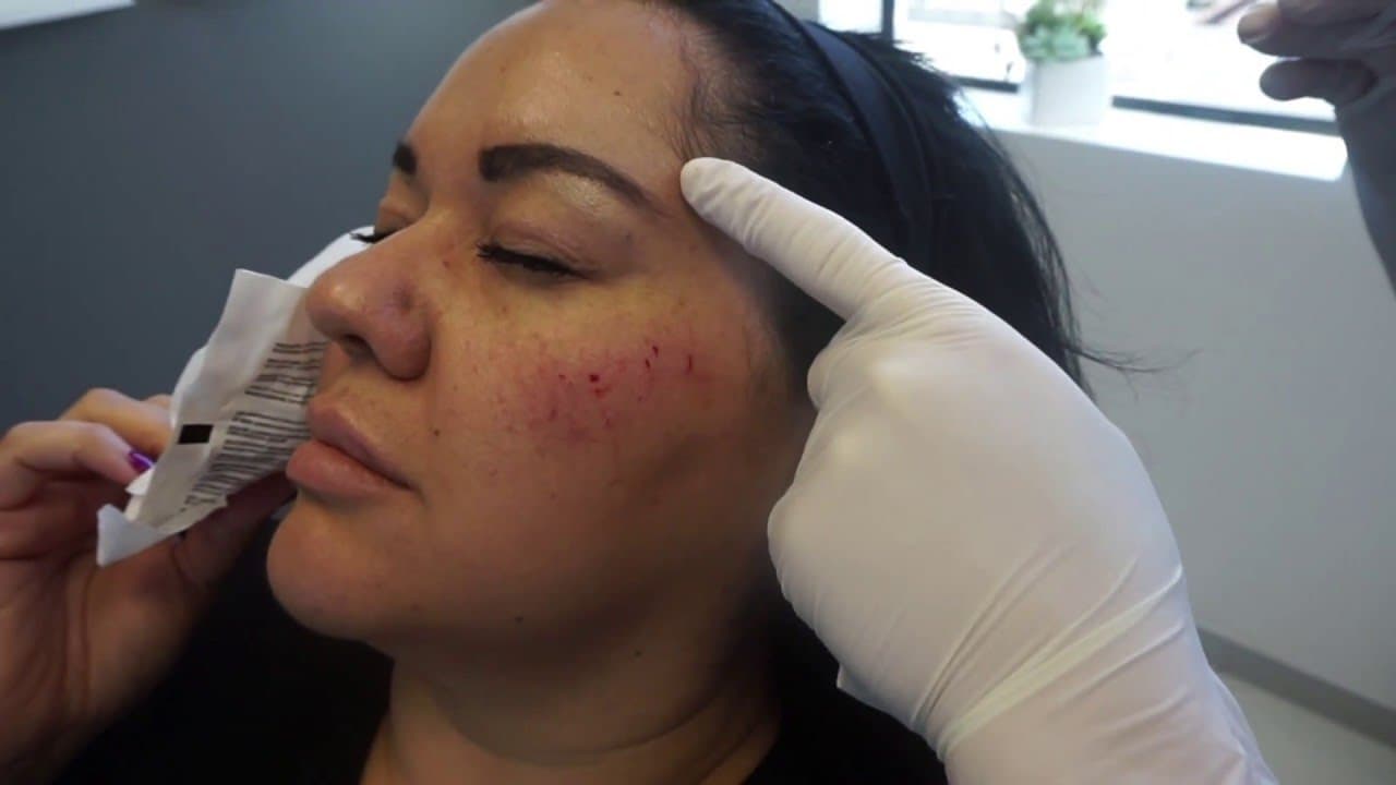 Watch a temple augmentation procedure video