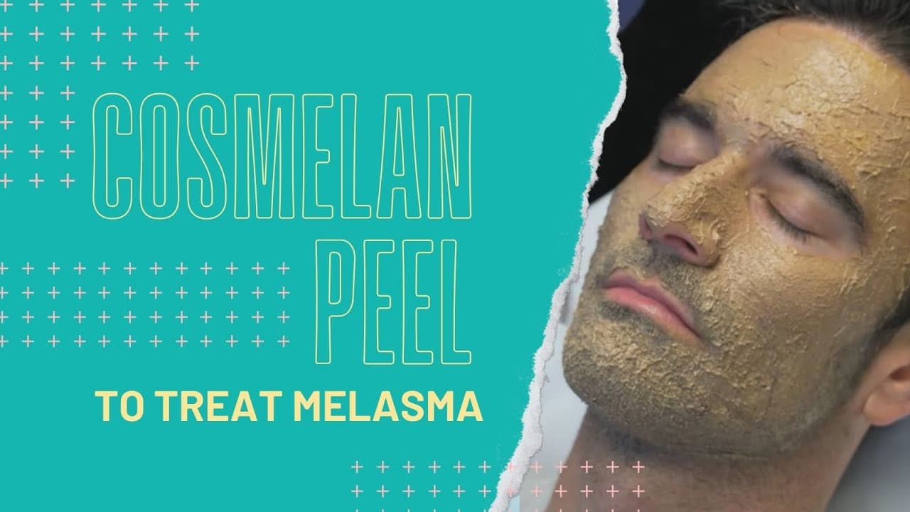 Melasma Treatment