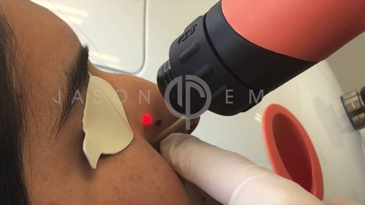 Watch a moles procedure video