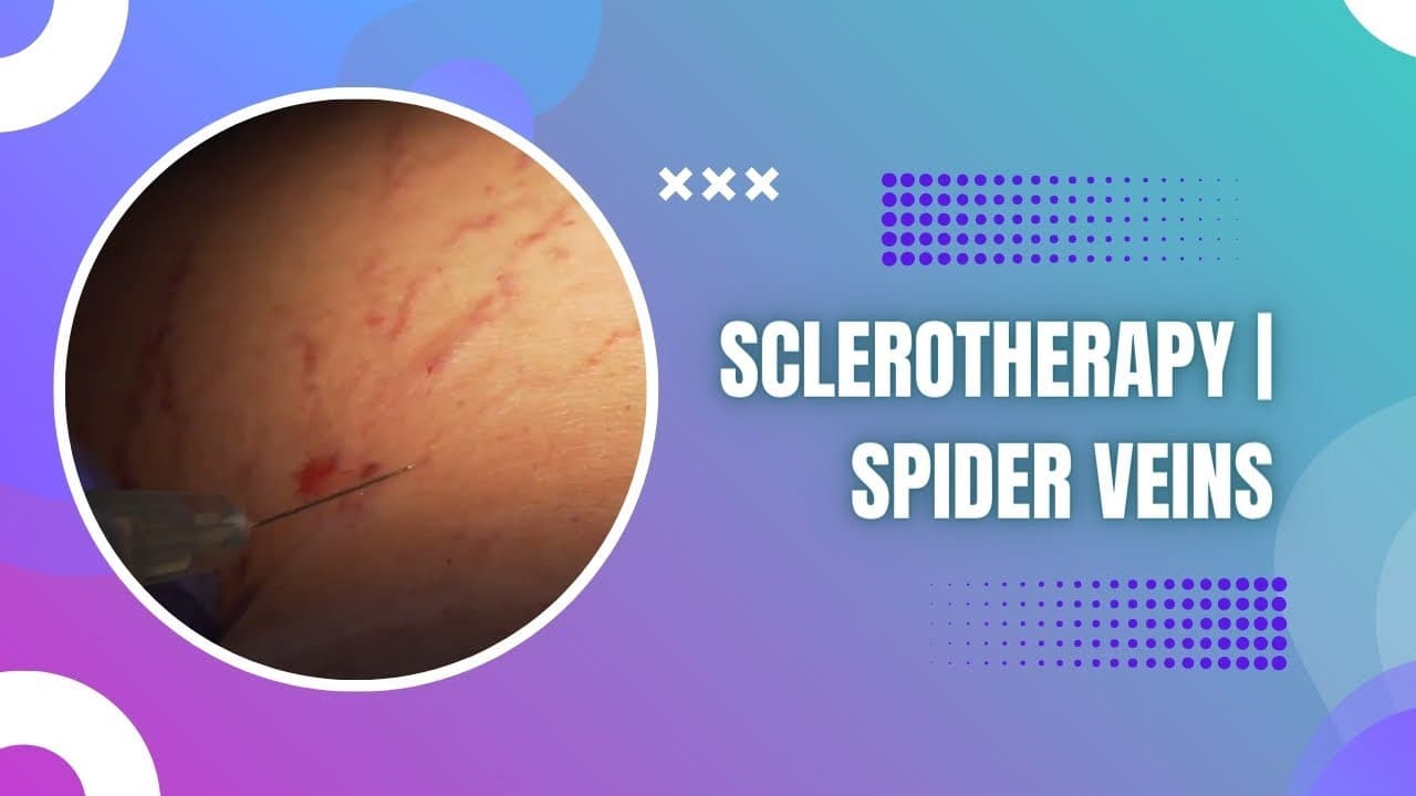 Watch a vein treatment procedure video