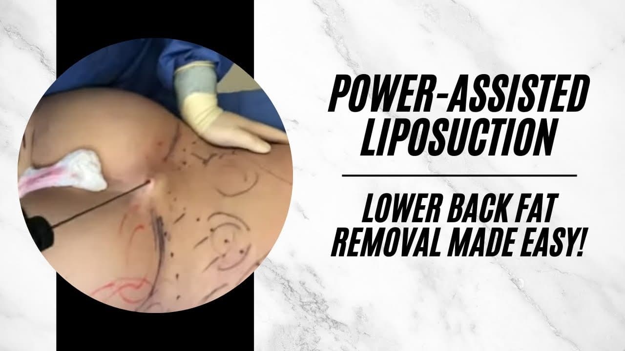 Back Lipo for Men procedure video