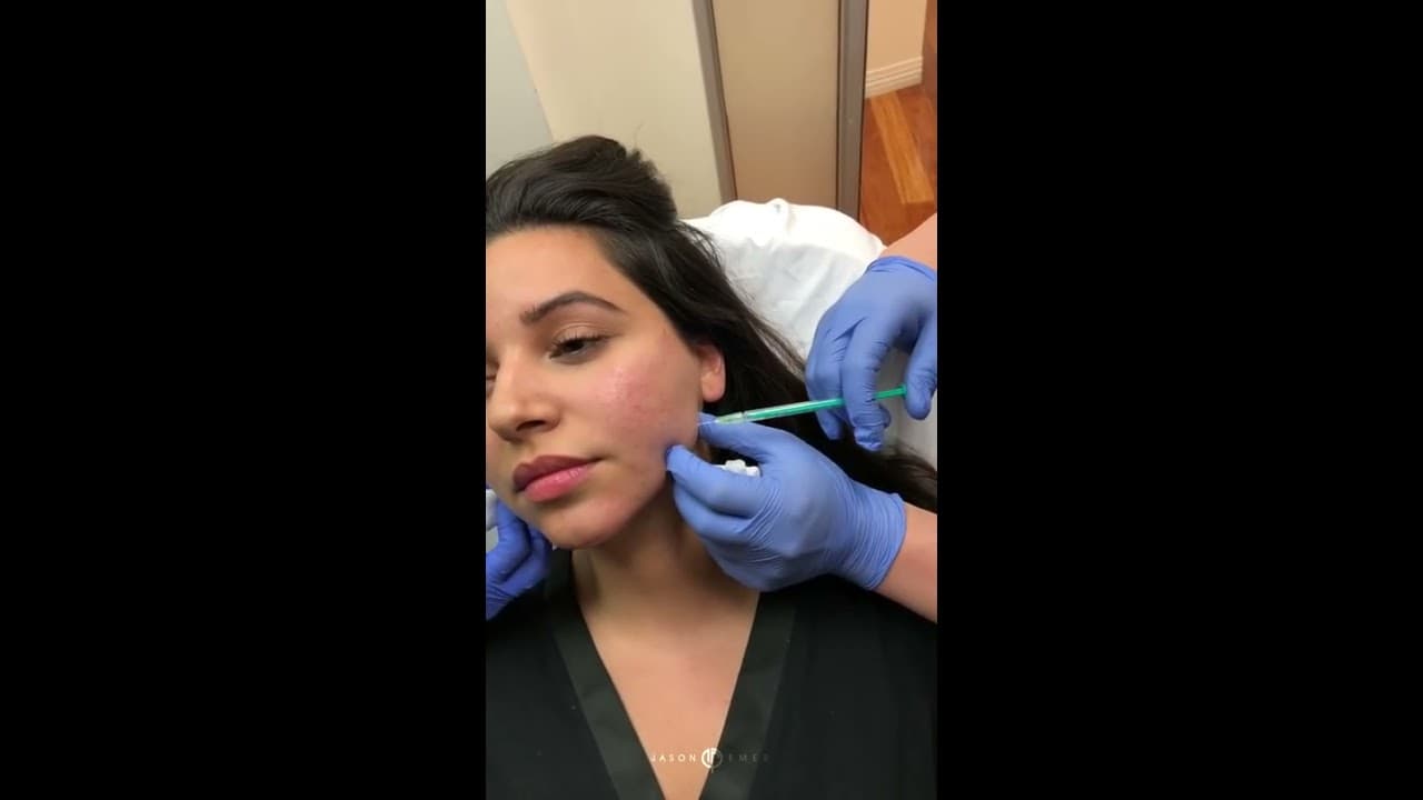 Watch a facial sculpting procedure video