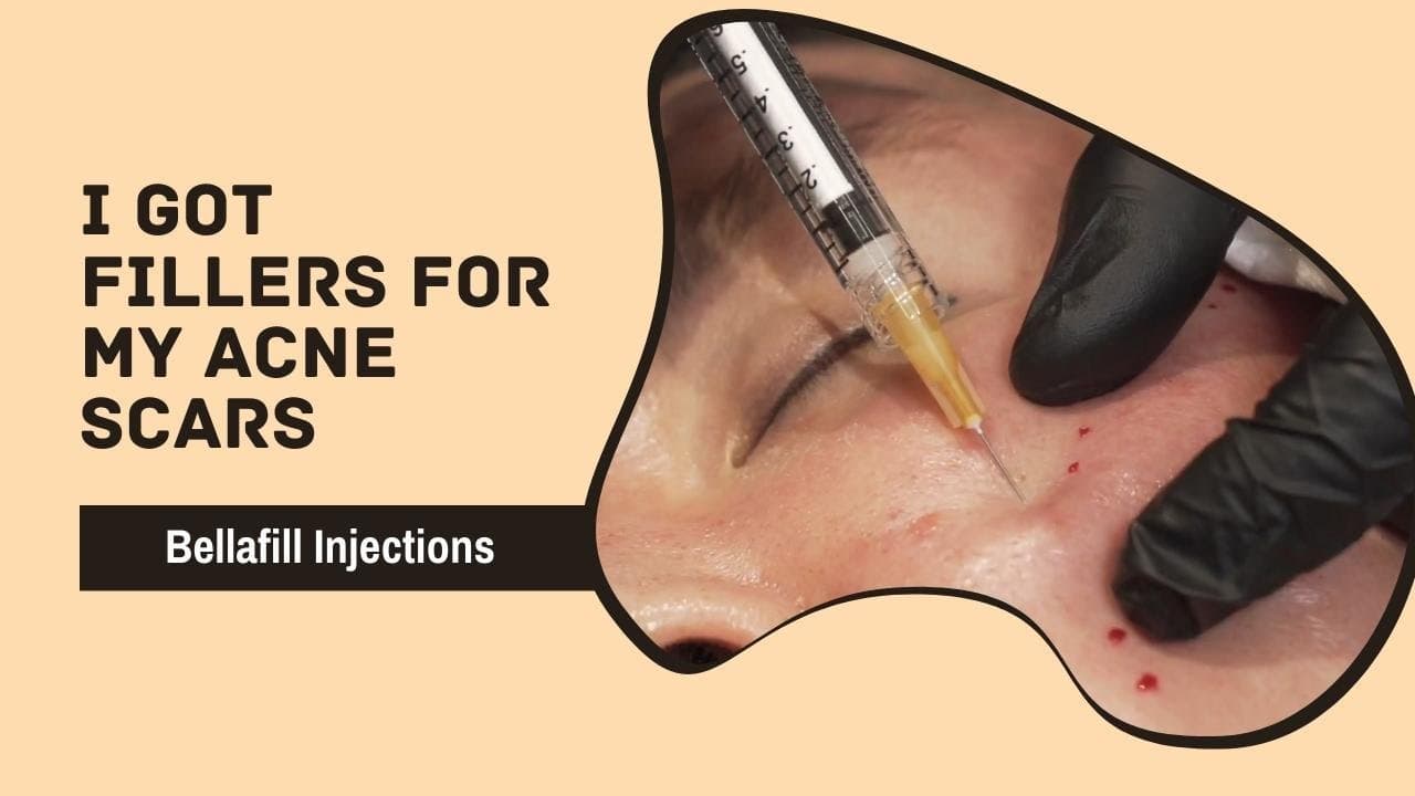 Watch a acne scar treatments procedure video