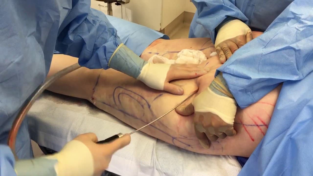 Watch a cellfina procedure video