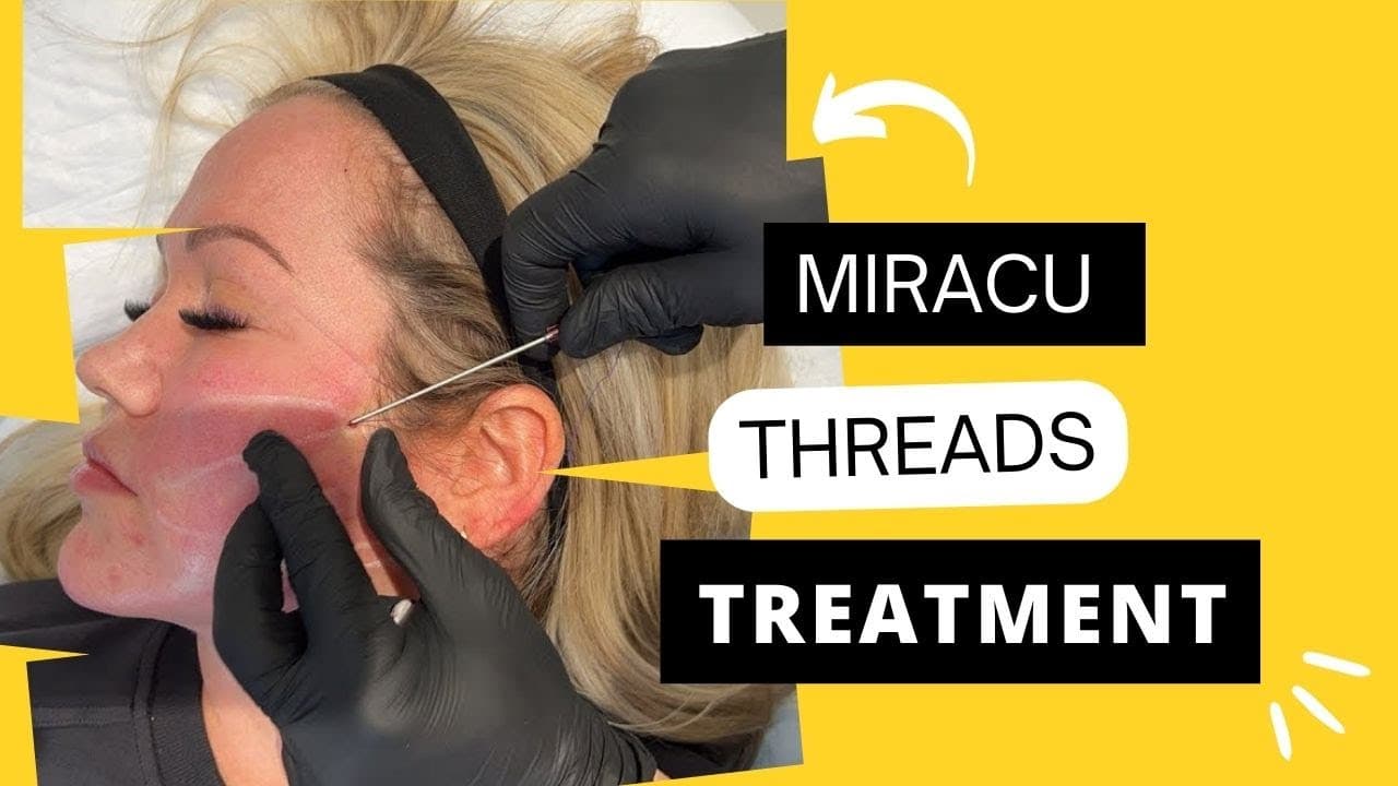 Watch a radiesse procedure video