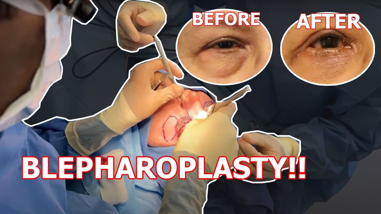 Watch a upper blepharoplasty procedure video