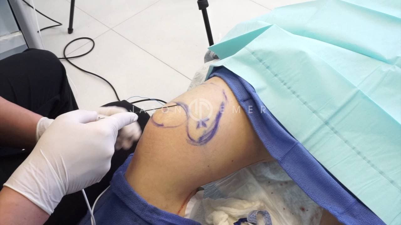 Patient story video 3