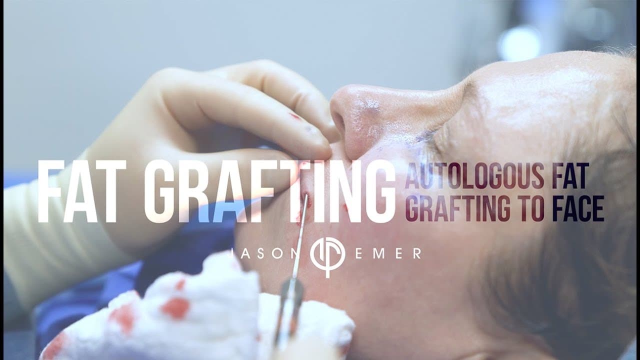 Watch a autologous fat grafting provides permanent volumization, shaping, sculpting, and muscular definition enhancements procedure video