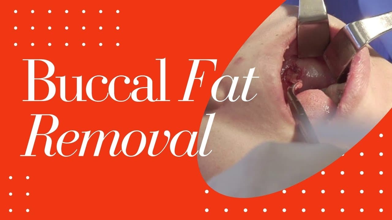 Watch a buccal fat removal for women procedure video