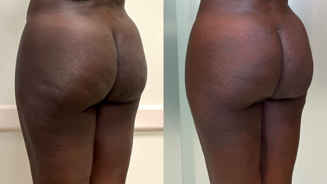 Avéli cellulite treatment before-and-after result by Dr. Jason Emer in West Hollywood, California
