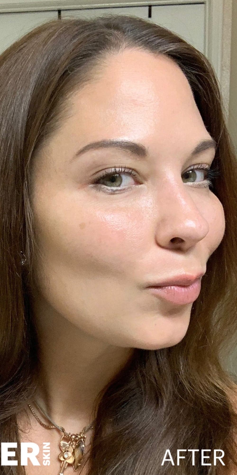 CELESTA Facial Sculpting — After