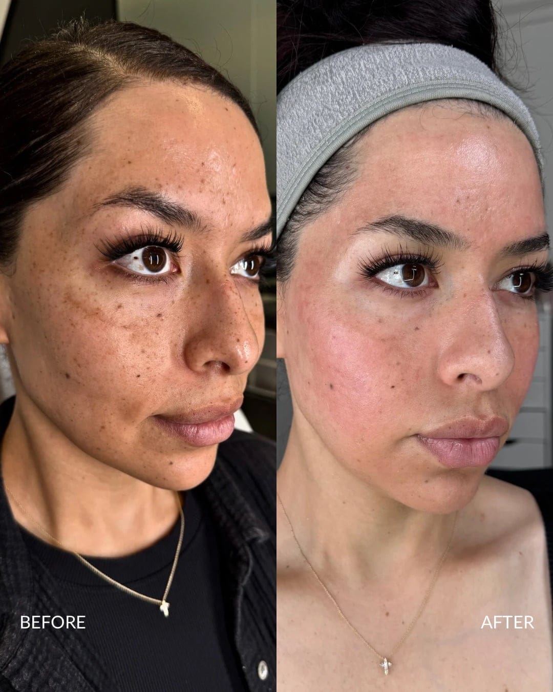 Acne Scar Reconstruction Before and After