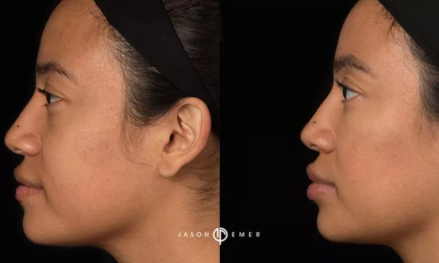 Rejuvenate with injectable fillers