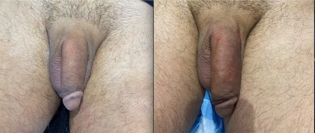 240220-3of3-1080x458 Penile Fat Injection