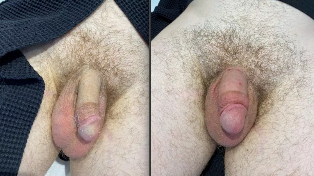 240250-1of3-1080x605 Penile Fat Injection