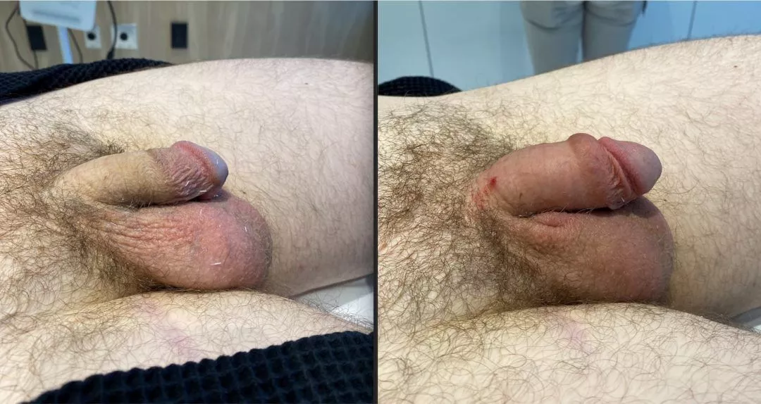 240250-3of3-1080x574 Penile Fat Injection