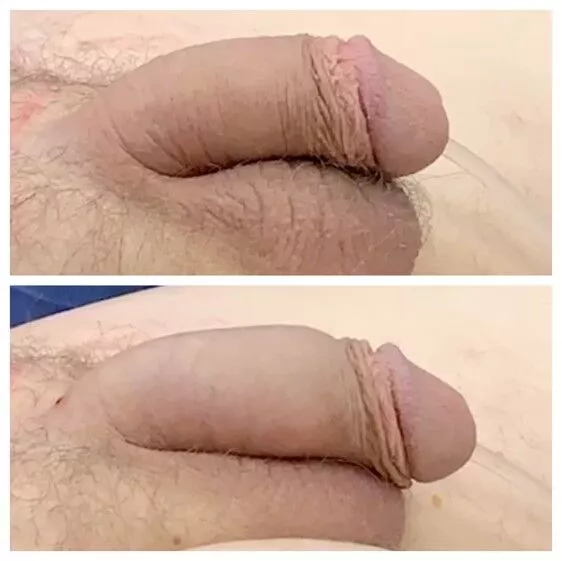 240285-2of2 Penile Fat Transfer