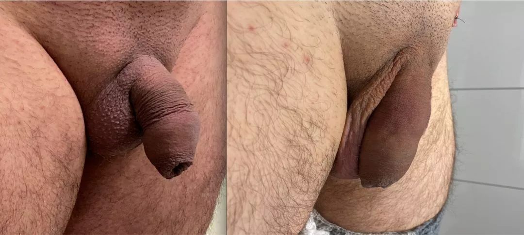 240297-1of2-1080x486 Penile Fat Transfer