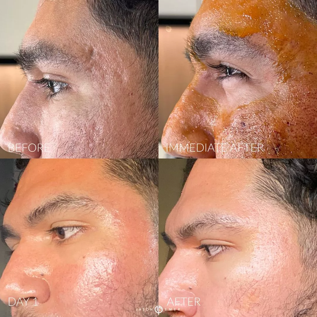 ACNE-SCAR-COMBINATION-TREATMENT-BXA-1080x1080