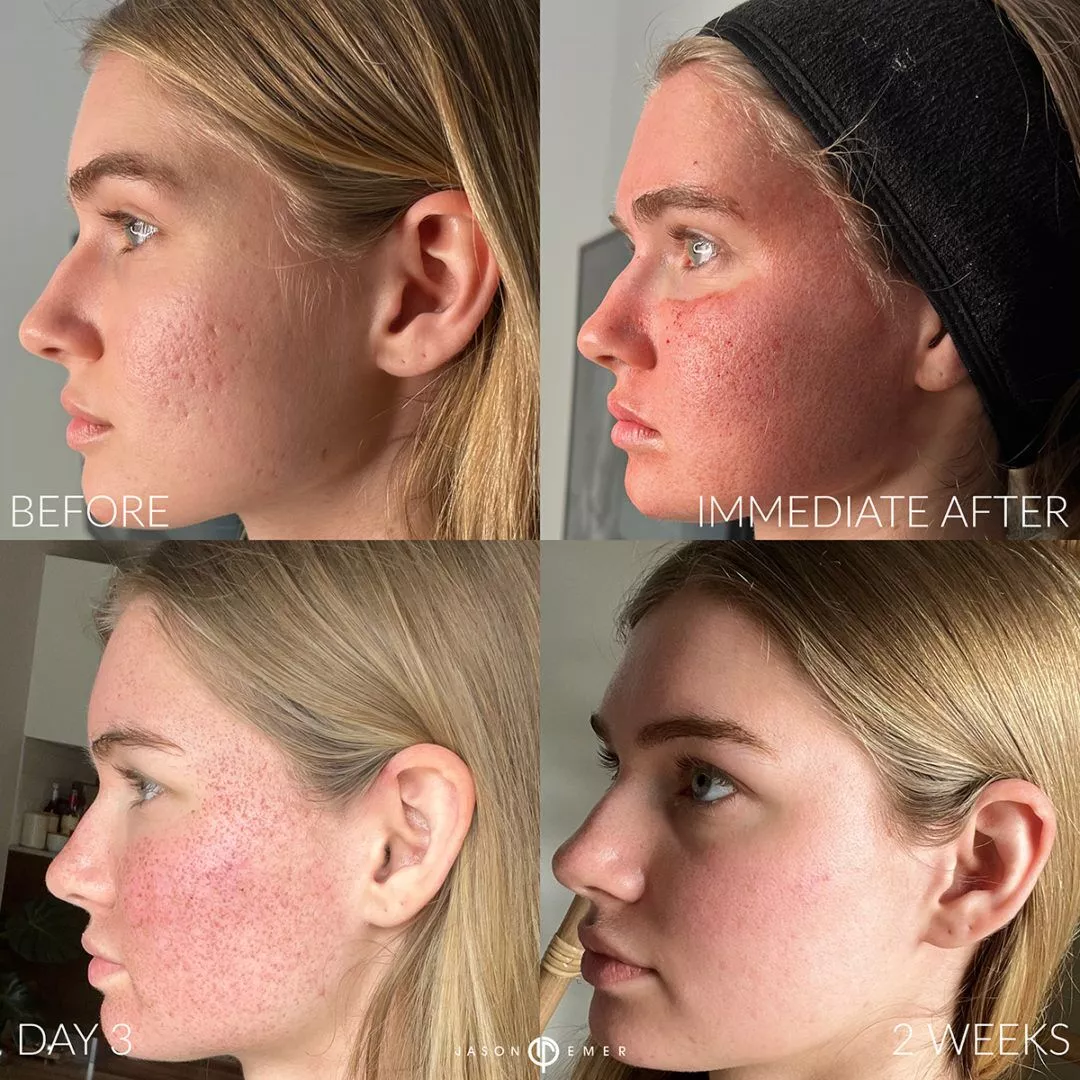 Acne-bxa-1080x1080