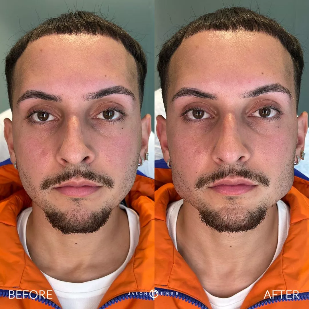 Facial-Sculpting-Male-bxa-1-1080x1080