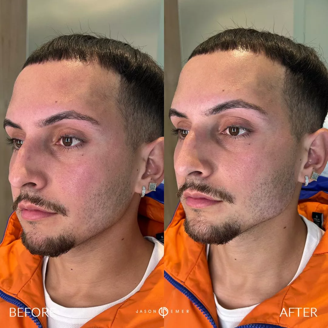 Facial-Sculpting-Male-bxa2-1-1080x1080