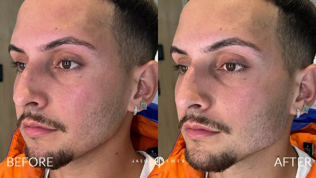 Facial-Sculpting-Male-bxa3-1-1080x608