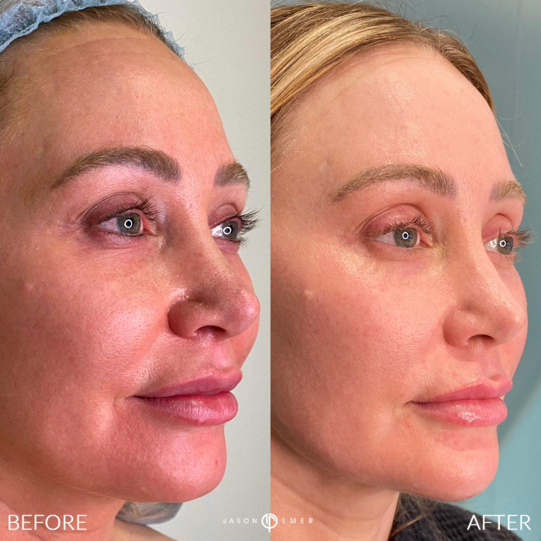 Facial-Sculpting-Side-Profile-2-1080x1080