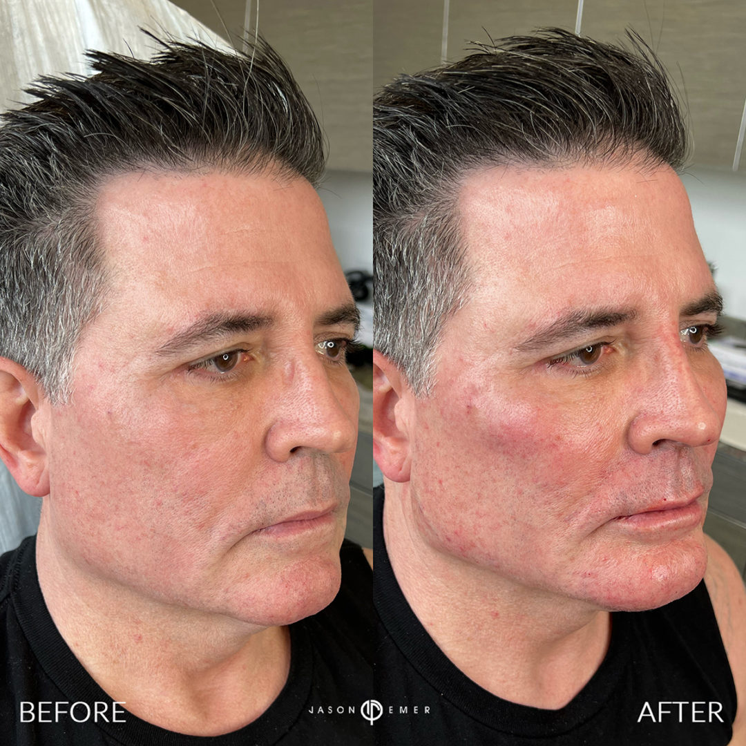 SUPERHERO-FACIAL-MASCULINIZATION-BXA1-1080x1080