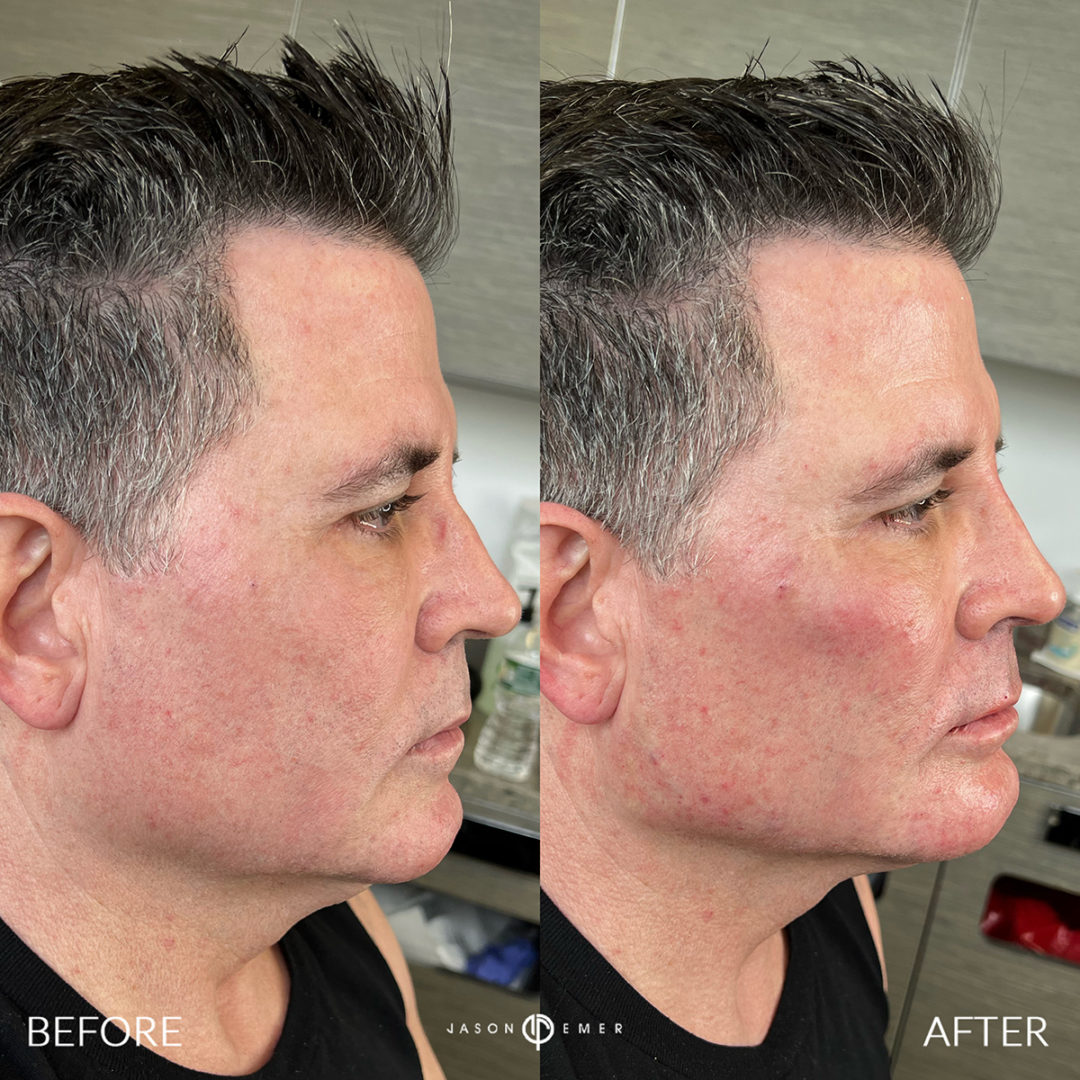 SUPERHERO-FACIAL-MASCULINIZATION-BXA3-1080x1080