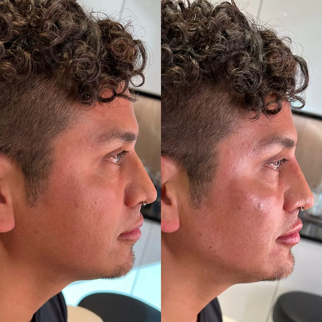 facial-sculpting-male-bxa2-1080x1080