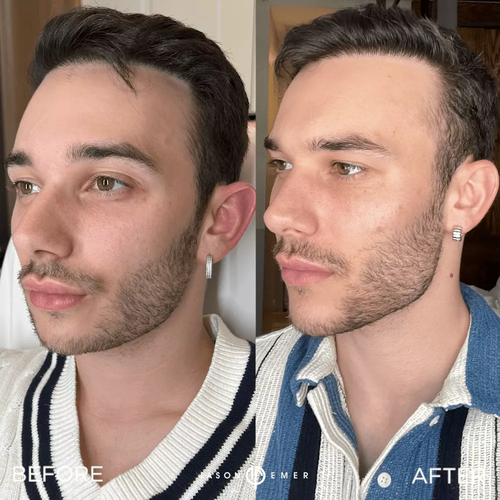 facial-sculpting-male-bxa2