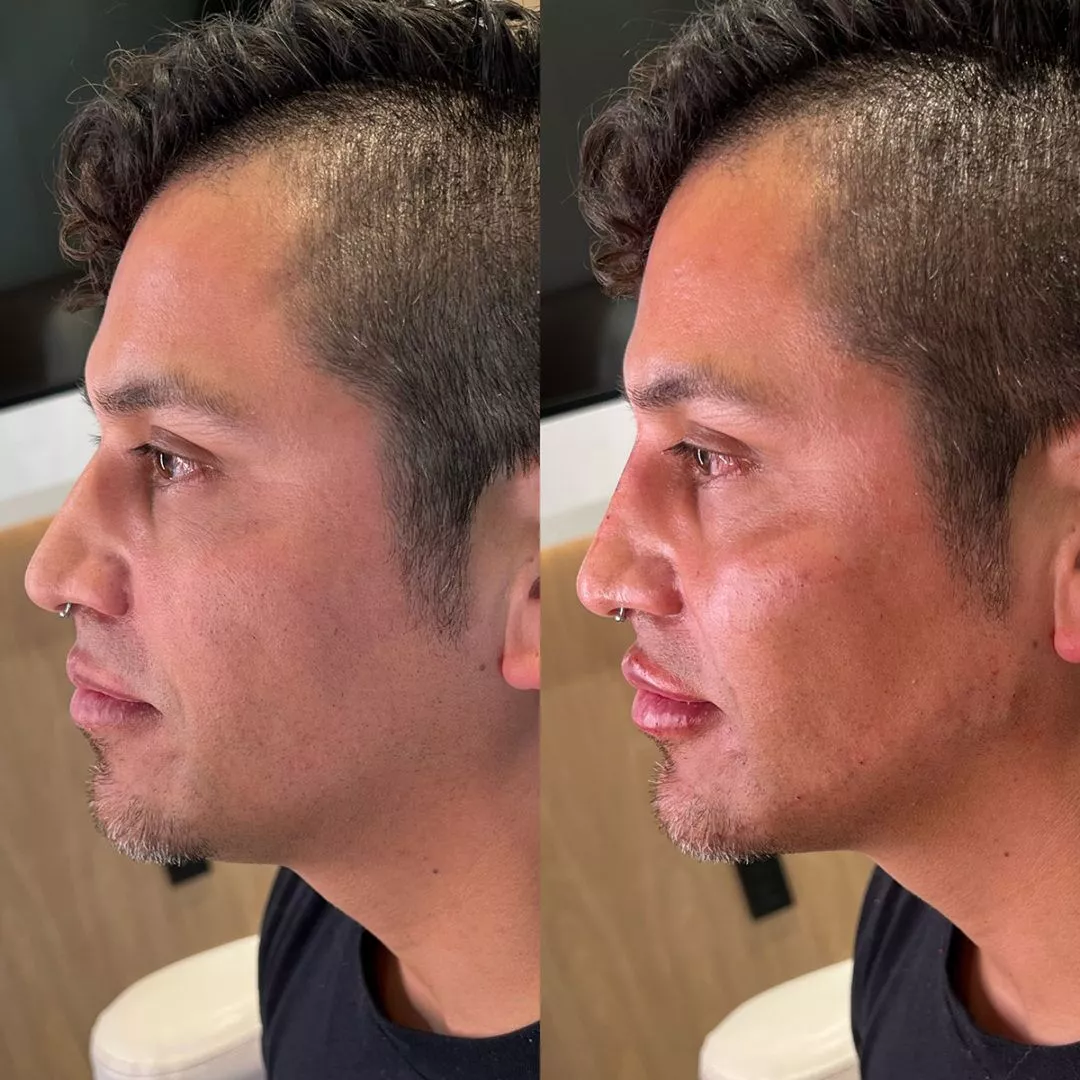 facial-sculpting-male-bxa3-1080x1080