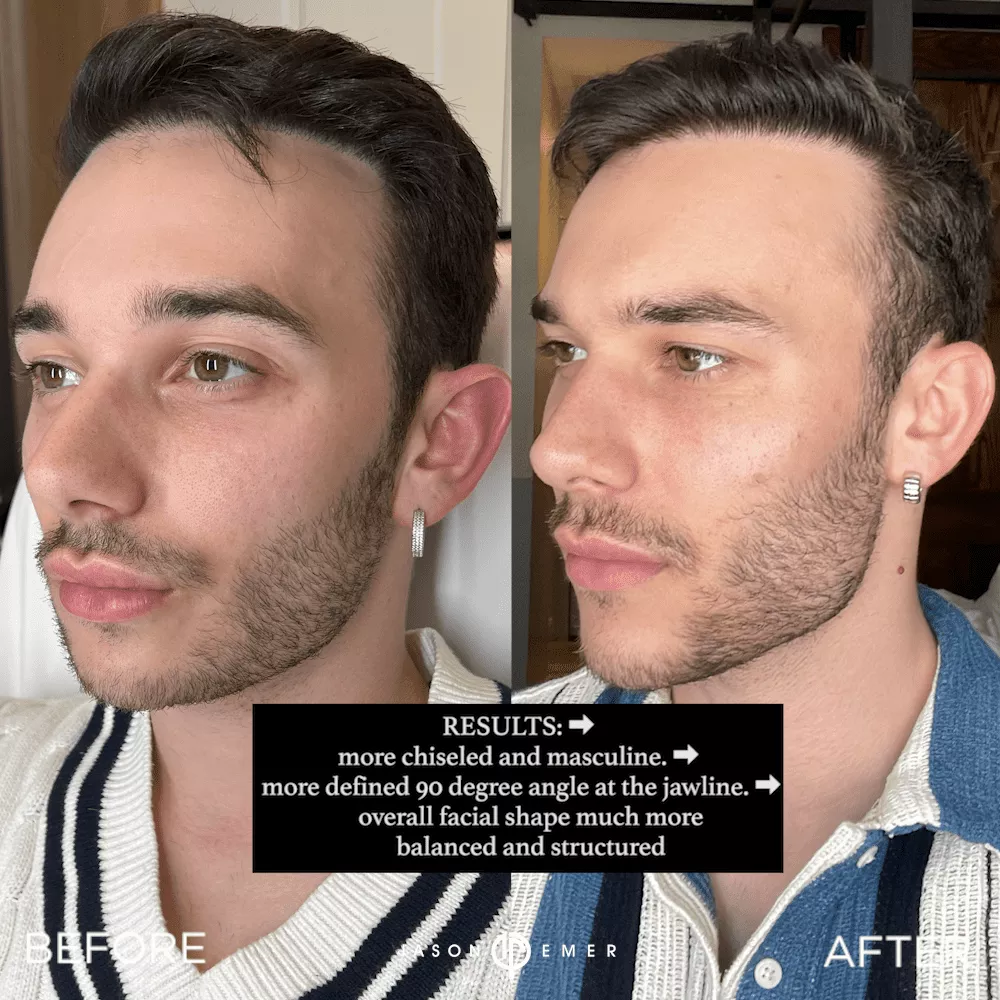 facial-sculpting-male-bxa3