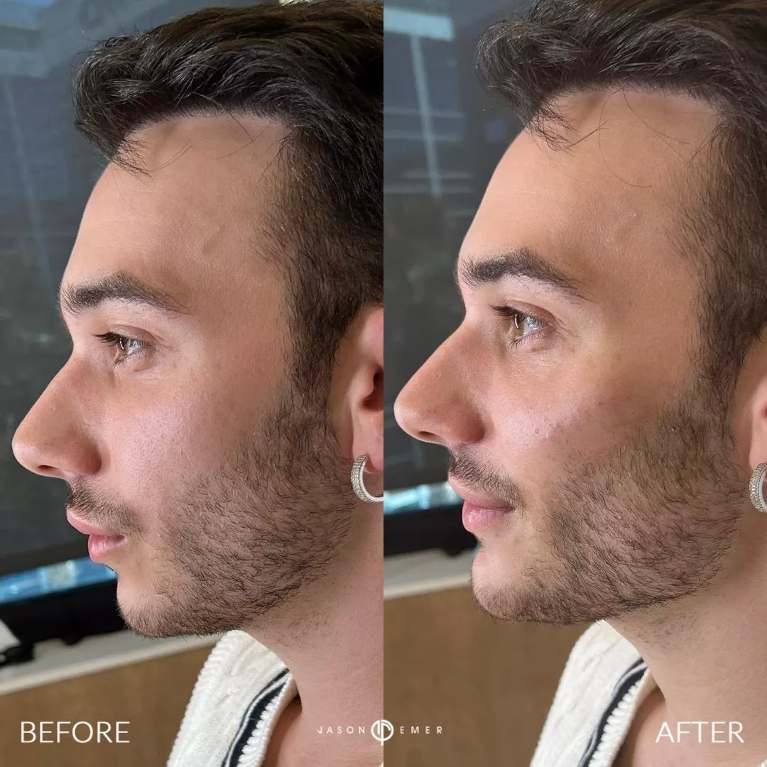 facial-sculpting-male-bxa4-1080x1080