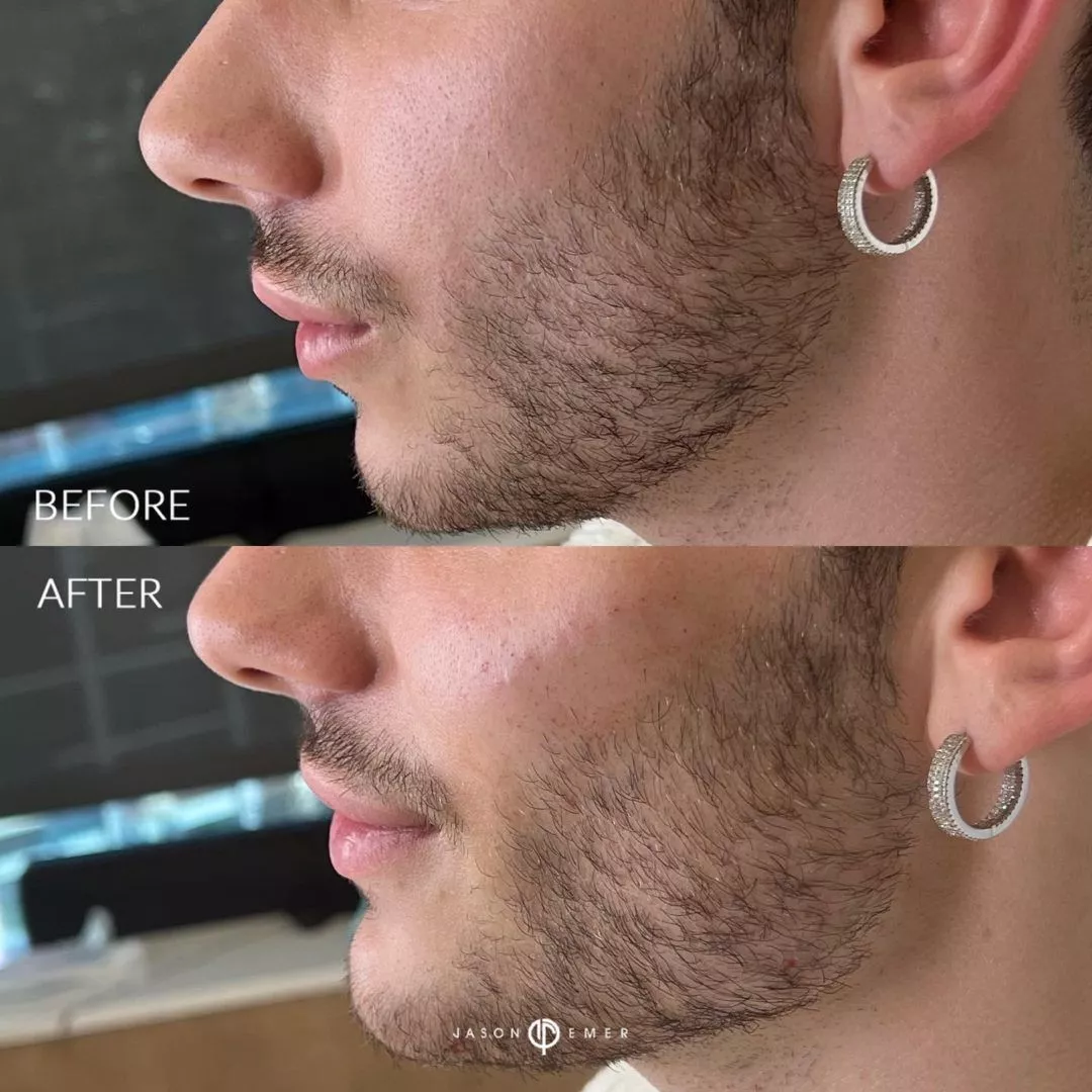 facial-sculpting-male-bxa5-1080x1080