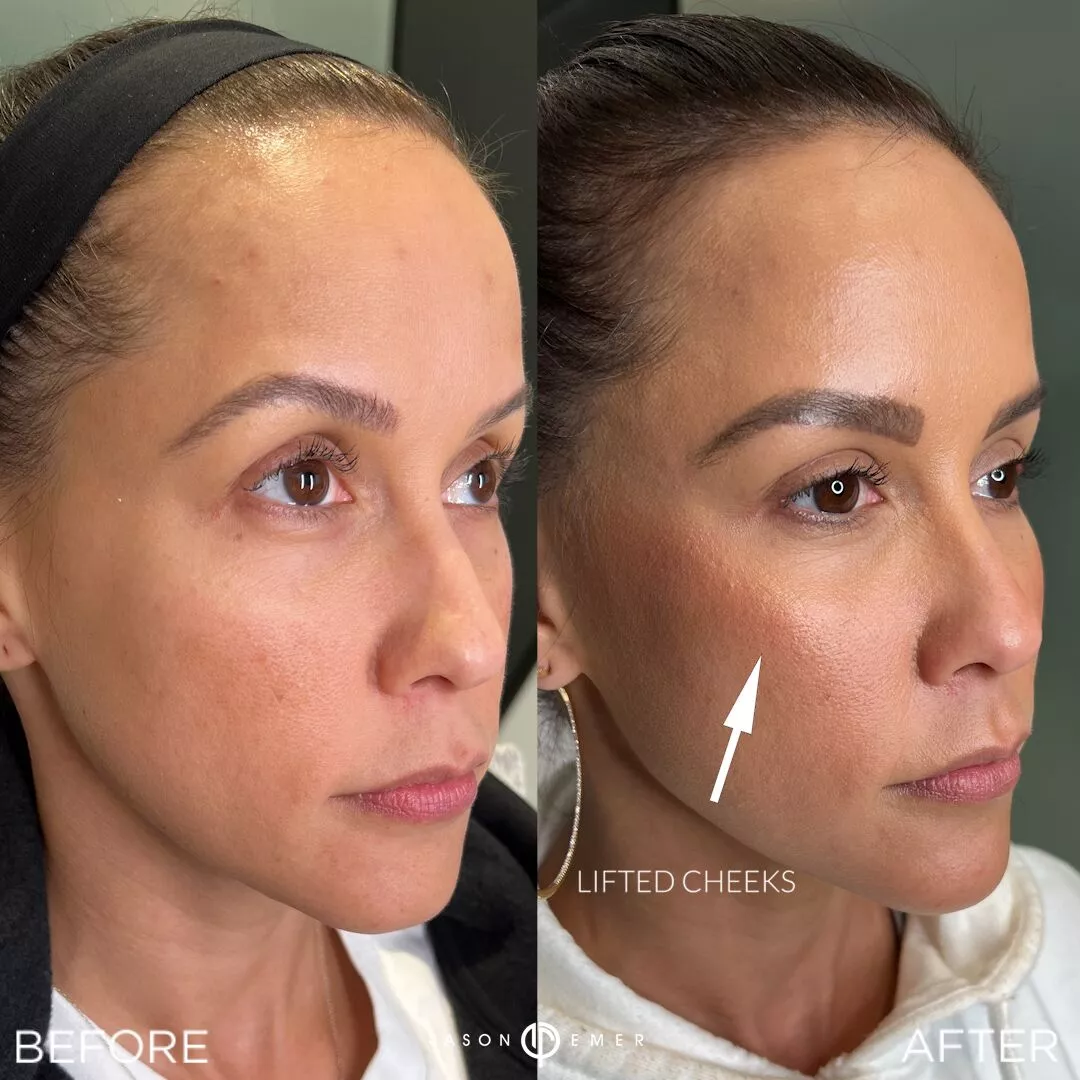 female-facial-sculpting-bxa2-1
