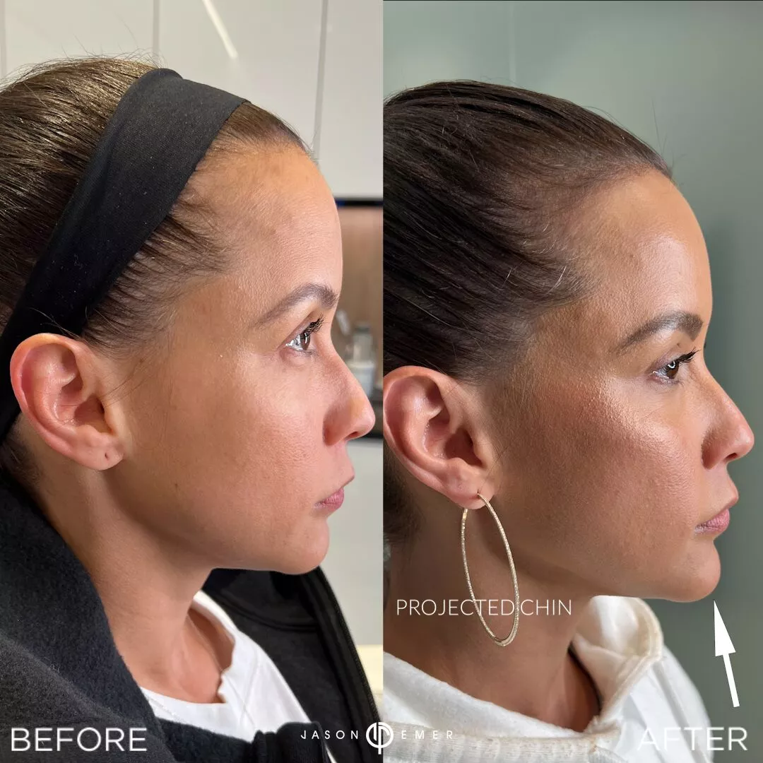 female-facial-sculpting-bxa3-1