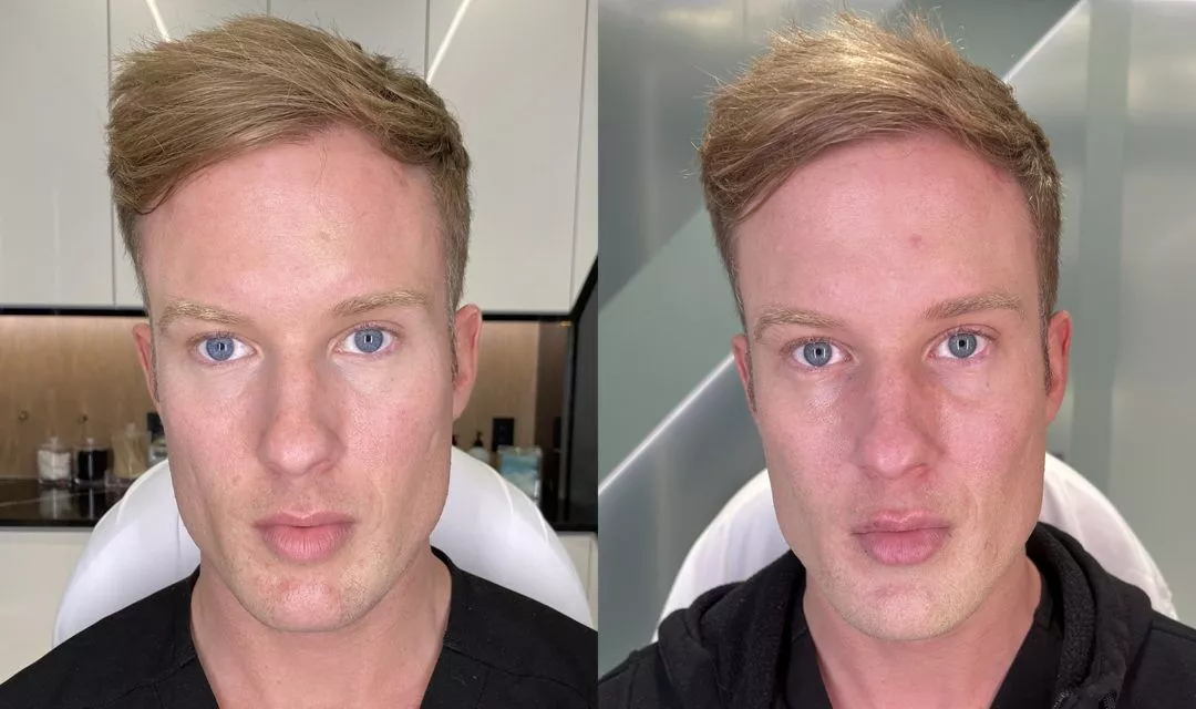 male-facial-sculpting-bxa-1-1080x640