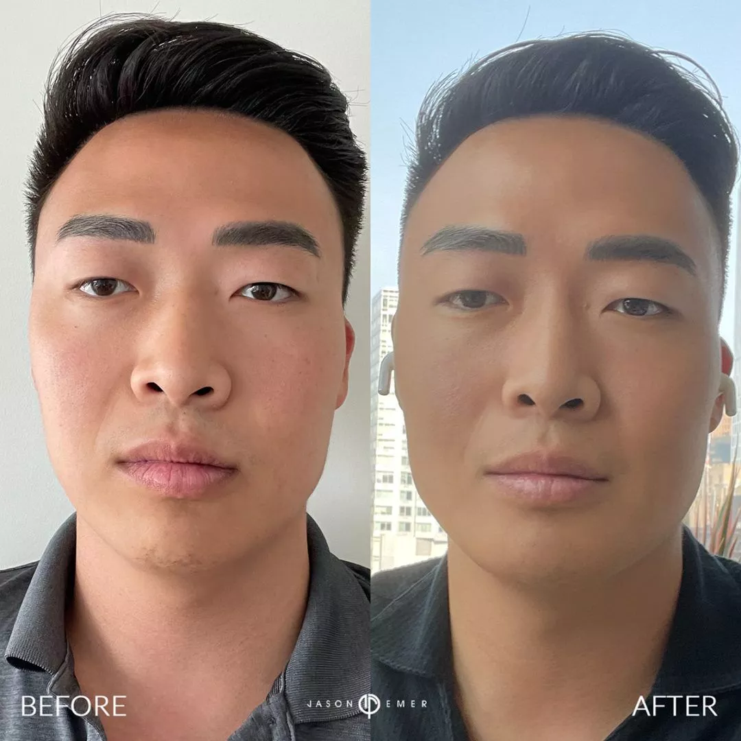 male-facial-sculpting-bxa-1080x1080