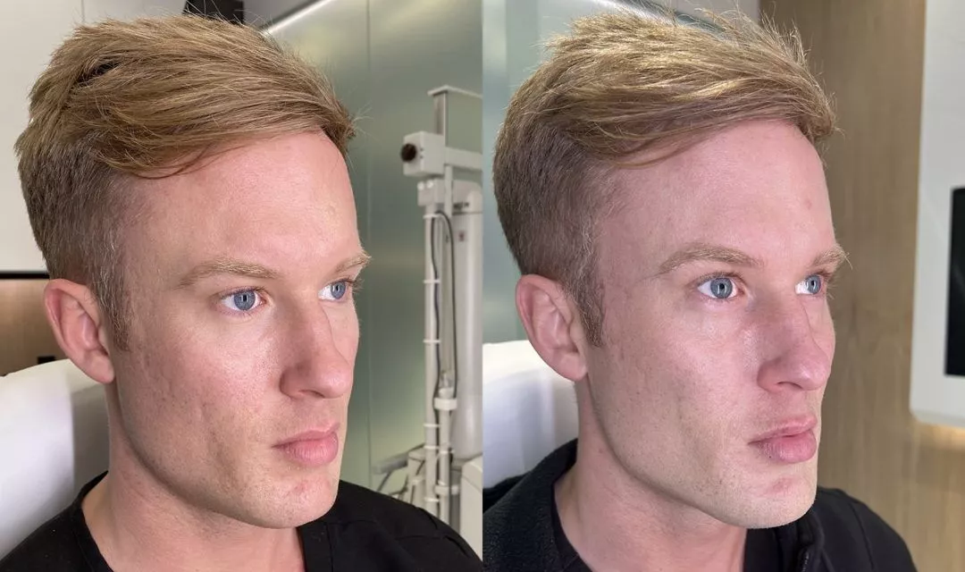 male-facial-sculpting-bxa2-1-1080x640