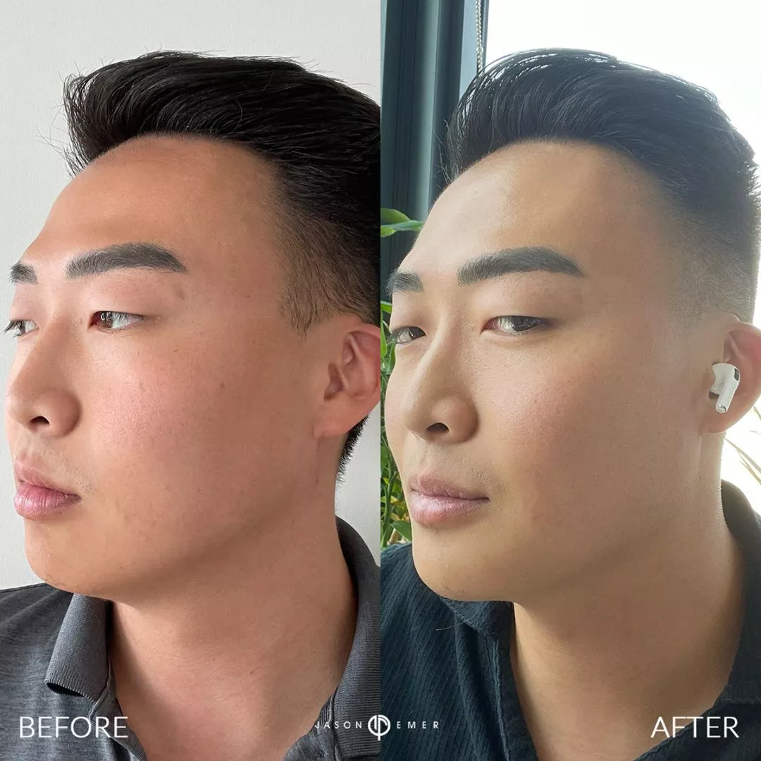 male-facial-sculpting-bxa2-1080x1080