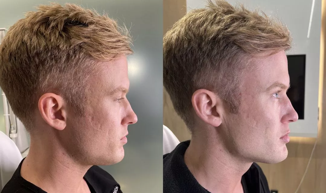 male-facial-sculpting-bxa3-1080x640