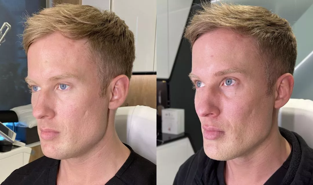 male-facial-sculpting-bxa4-1080x640