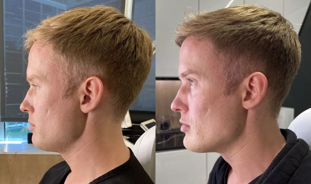 male-facial-sculpting-bxa5-1080x640