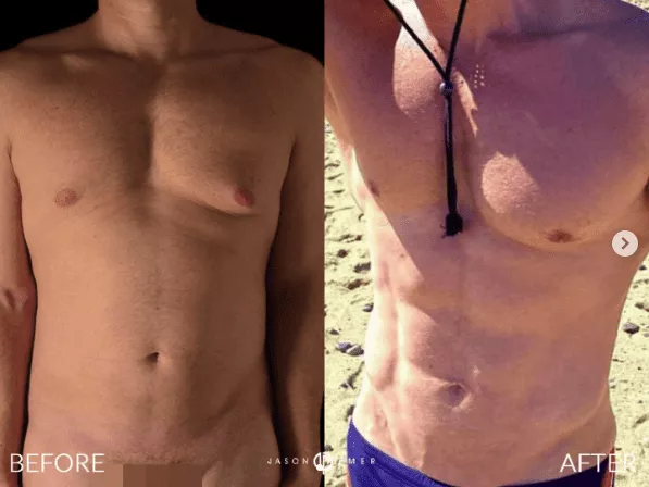 Transform Your Body with High Definition Liposuction